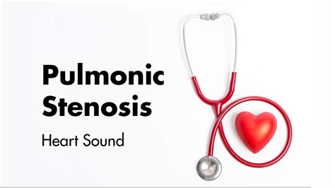 Healthy Lifestyle and Pulmonary Stenosis